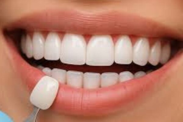 Veneers