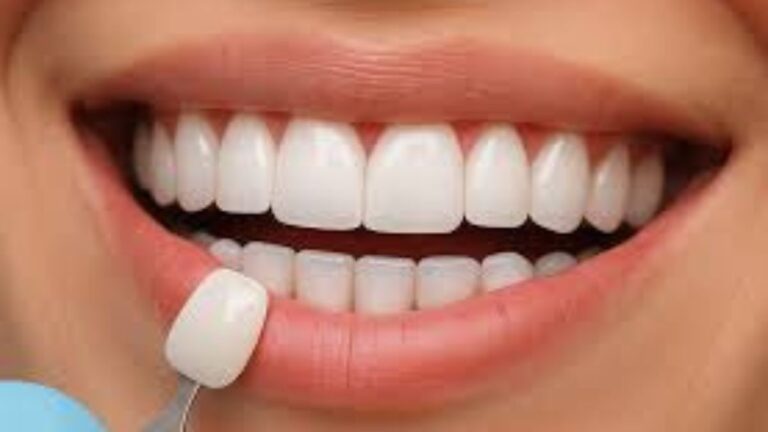 Veneers
